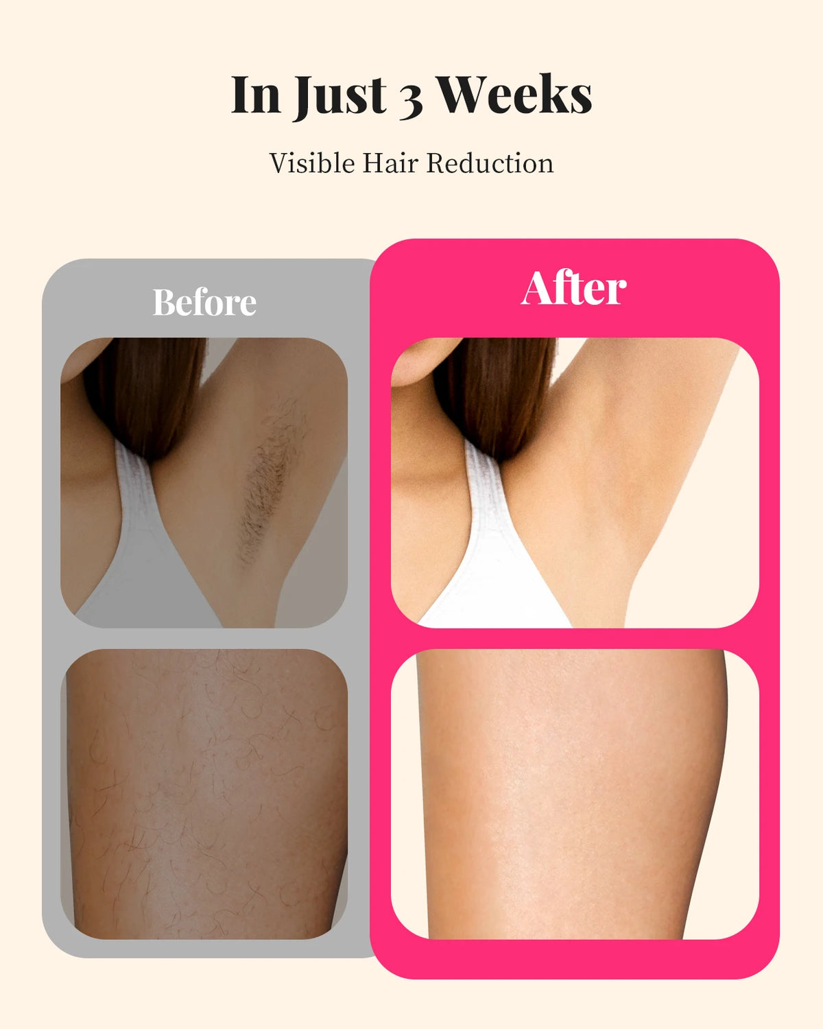 Totmizby Ipl Hair Remover For Women Men Face Bikini